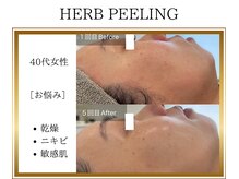 ロージー(ROSY)/ハーブピーリング/阿南/徳島