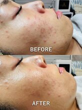 ルーク(Luke)/ニキビケア