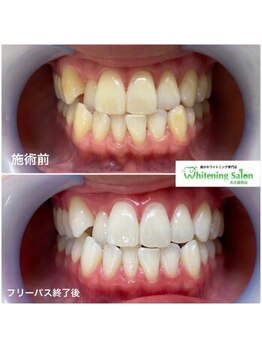 ホワイトニングサロン 名古屋駅店/【ホワイトニング施術例】
