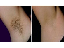 サロン レピア(LEPIA)/効果は、、、