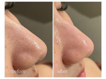 ミニョン(mignon)/ハイドラフェイシャル(毛穴洗浄)