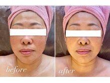 ビジュー(bijou)/50代のお客様/小顔/よもぎ蒸し/