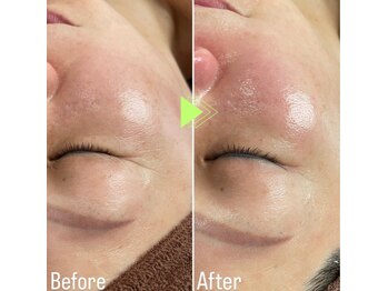 ステラ(STELLA)/ラミネーションピーリング