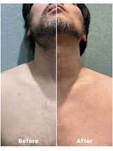 エイト(eight)/ヒゲ脱毛　Before → After