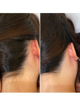 インベスト(INVEST)/うなじ脱毛