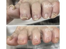 リゼラアンドコー 布施店/足爪ケア！