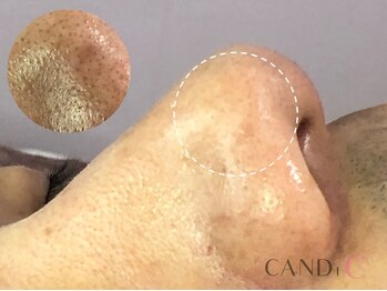 キャンディ 難波心斎橋店(CANDi)/ハイドラピーリング/黒ずみ毛穴