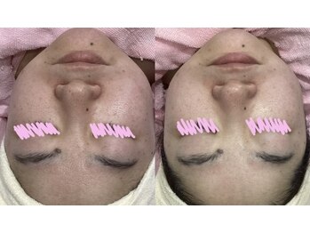 じゅえる/シミケアとエステのWの効果