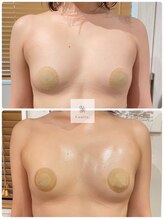 エミット(emit.)/脂肪増加バストアップ