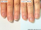 自爪育成・深爪・川崎