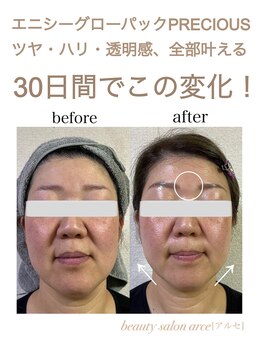 アルセ(arce)/エニシーグローパック