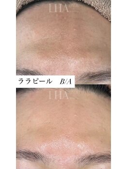 ミセルビューティー 御堂筋本町(micell beauty)/ララピール