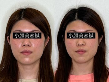 コガオ レンネ(Lenne)/