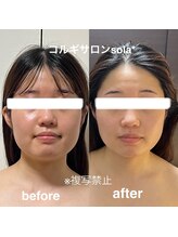 ソラ(sola*)/フェイスラインで垢抜ける