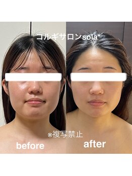 ソラ(sola*)/フェイスラインで垢抜ける