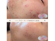 ニキビのお悩み改善