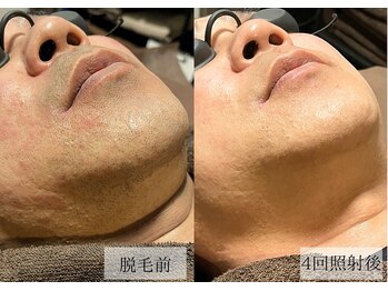 メンズアルファ/【髭】光脱毛before after 40代