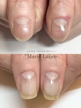 マリーロール 淀屋橋本店(Marie Laure)/自爪育成/深爪矯正/ネイルケア