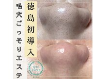 きれいのココロミ(CoCoRomi)の雰囲気（頑固な毛穴の皮脂詰まりや黒ずみ。1回のエステでごっそりお掃除!）