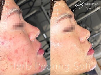 ベル 調布(Belle)/ハーブピーリング|ニキビケア
