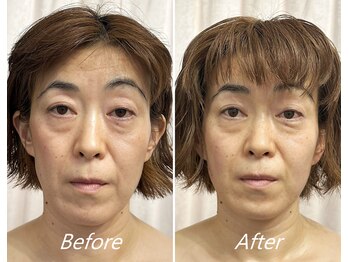 ドクターボディ 新宿店(Dr.Body)/【たるみ/顔の長さ/中顔面40代】