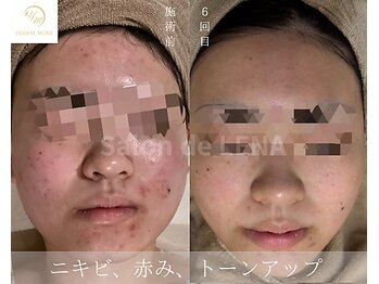 サロンドレナ 名駅店/ハーブピーリング サロンドレナ