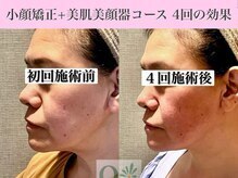 キュープ 福岡九大学研都市店(Qpu)/美顔器モニターコース４回の変化