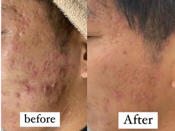 カノネ(Cannone')/ハーブピーリング / ニキビケア