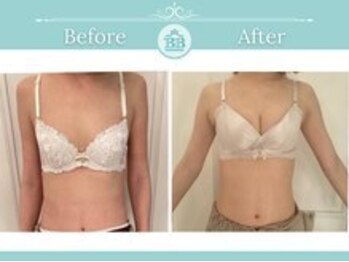 ベルビューティー(belle beauty)/【サイズアップ/C以下】症例写真
