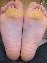 ビサンテ サロン/酷い足裏の肥厚角質,たこに人気