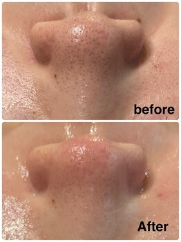 アムール(Amour)/waxxxx フェイシャルwax