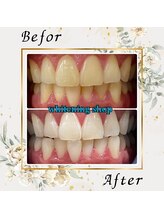 ホワイトニングショップ 宇都宮店/Before&After美白ホワイトニング