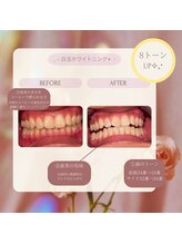 プラスビー 2号店(+b)/ホワイトニングビフォーアフター