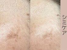 ベアール(beal)/シミ特化ハーブピーリング