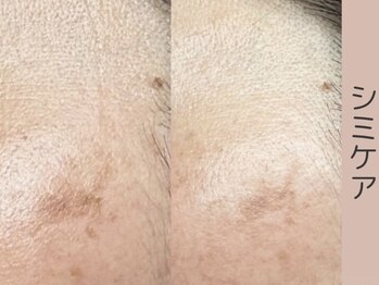 ベアール(beal)/シミ特化ハーブピーリング