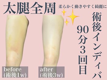 エステサロン ヴリエ 立川店/術後インディバ90分3回【３W後】