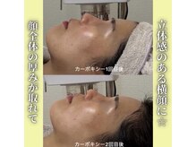 ハニエル(Haniel)/カーボキシー症例