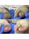 巻き爪カットの様子
