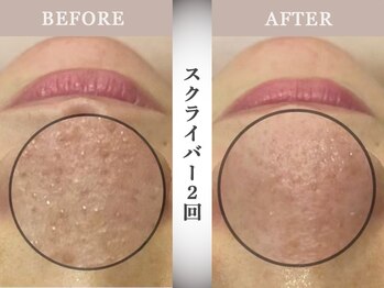 モルティー 小山店(Molti)の写真/【肌改善・毛穴洗浄サロン】黒ずみや詰まりをすっきり除去×BT-Xパックで毛穴引き締めツルツル肌をキープ!