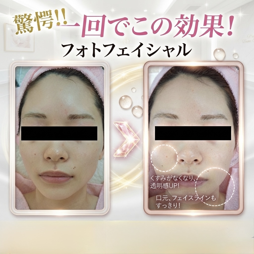 【シミ・くすみ・毛穴ケア】IPL光フェイシャル
