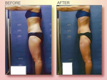 ジュリア オージェ 京都駅前店/ ビフォーアフター(脂肪燃焼)