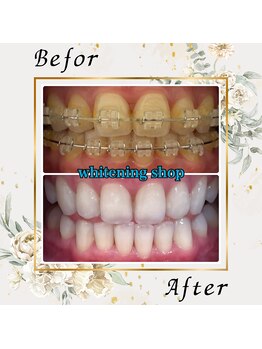 ホワイトニングショップ 宇都宮店/Before&After美白ホワイトニング