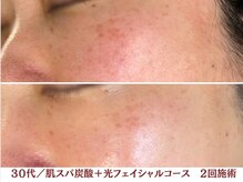 アリィ エステティック(allie esthetic)/【肌スパ炭酸＋光フェイシャル】