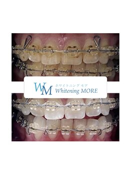 ホワイトニング モア(Whitening MORE)/矯正中でも大丈夫です◎