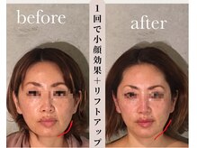 リラクゼーションハウス ミリミリ(Relaxation House mirimili)の雰囲気（当店人気の小顔施術。1回でリフトアップ、美しいフェイスライン）