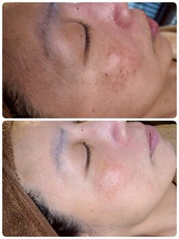 ケンビラク(Kenbiraku 健美楽)/ハイドラプラズマ　シミイレ-サ-