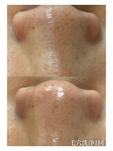 ココリール/毛穴洗浄1回