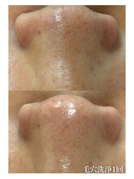 ココリール/毛穴洗浄1回