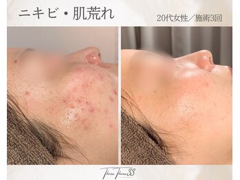 スリースリー(THREE THREE)/ニキビ・肌荒れ