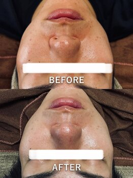 ルーク(Luke)/ニキビケア